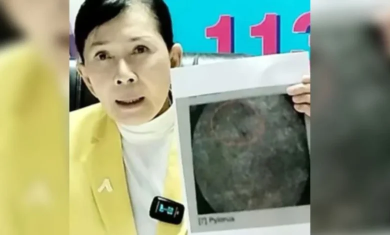 Derita 18 tahun kerana kes 'jarum tertinggal' ketika bersalin
