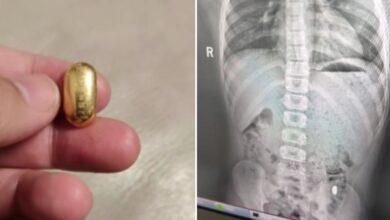 Budak tertelan ketulan emas bernilai hampir RM6,000