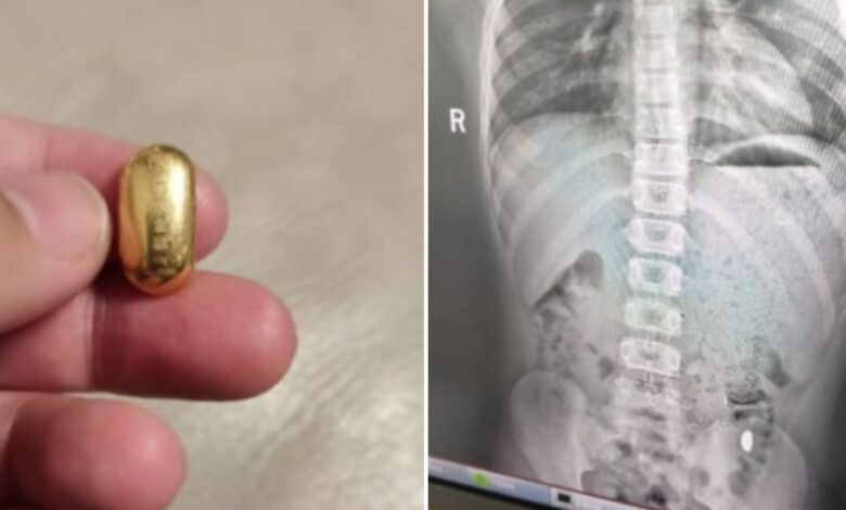 Budak tertelan ketulan emas bernilai hampir RM6,000