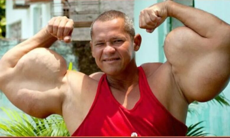 ‘Popeye’ Brazil miliki lengan terbesar meninggal dunia