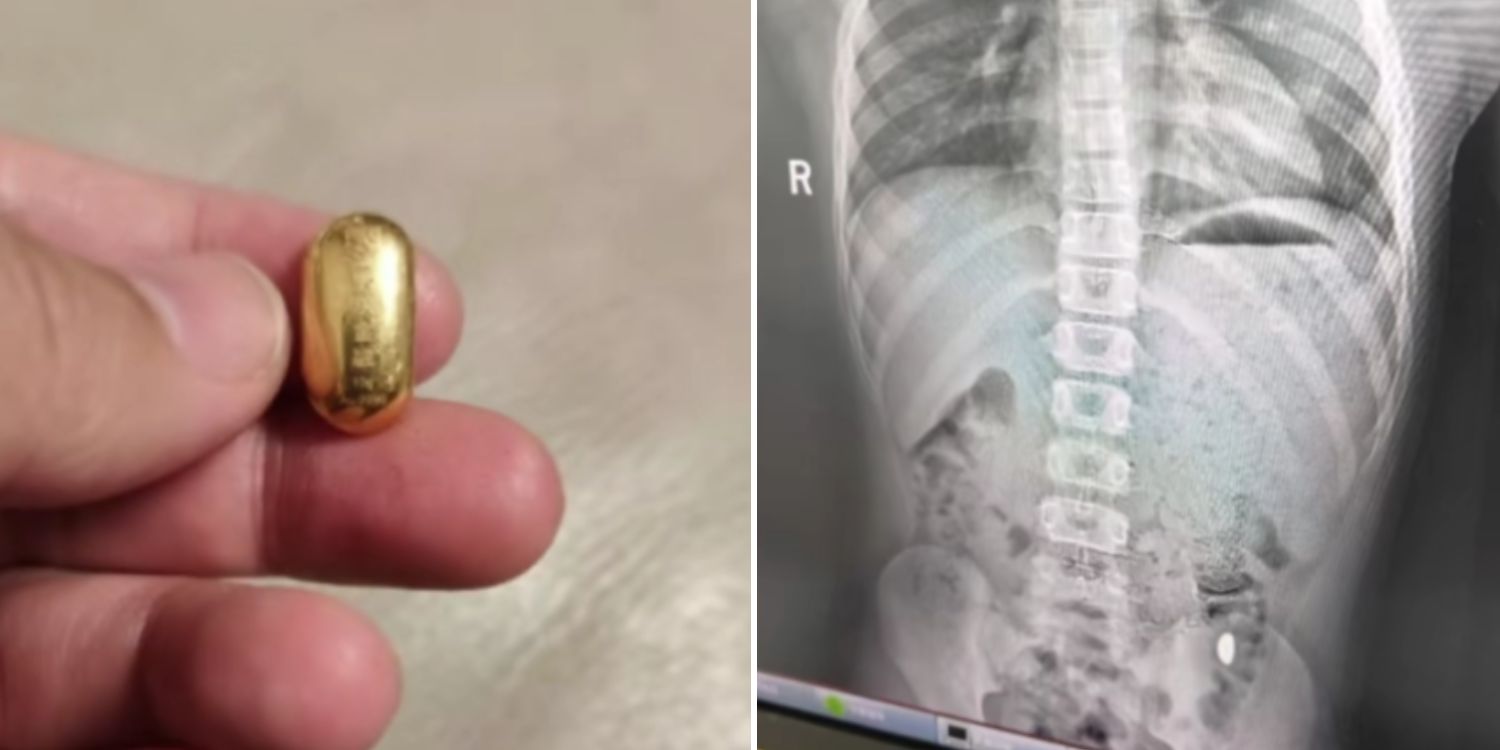 Budak tertelan ketulan emas bernilai hampir RM6,000