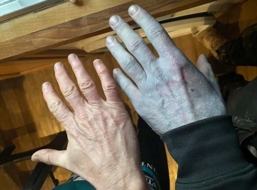 Kecoh badan lelaki bertukar biru, rupa-rupanya…