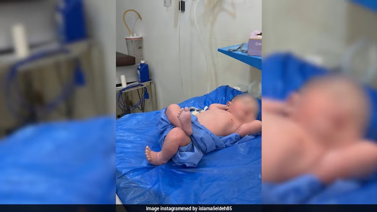 Siap silang kaki, bayi relaks selepas lahir